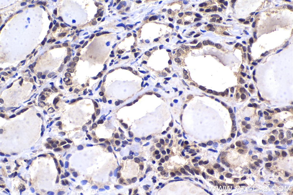 Immunohistochemical analysis of paraffin-embedded human thyroid cancer tissue slide using KHC1483 (TOX4 IHC Kit).