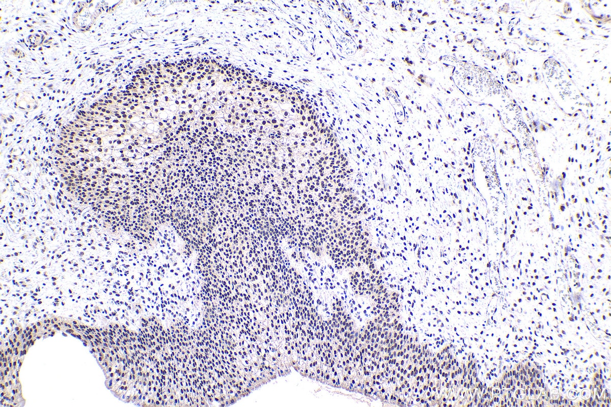 Immunohistochemical analysis of paraffin-embedded human urothelial carcinoma tissue slide using KHC1483 (TOX4 IHC Kit).