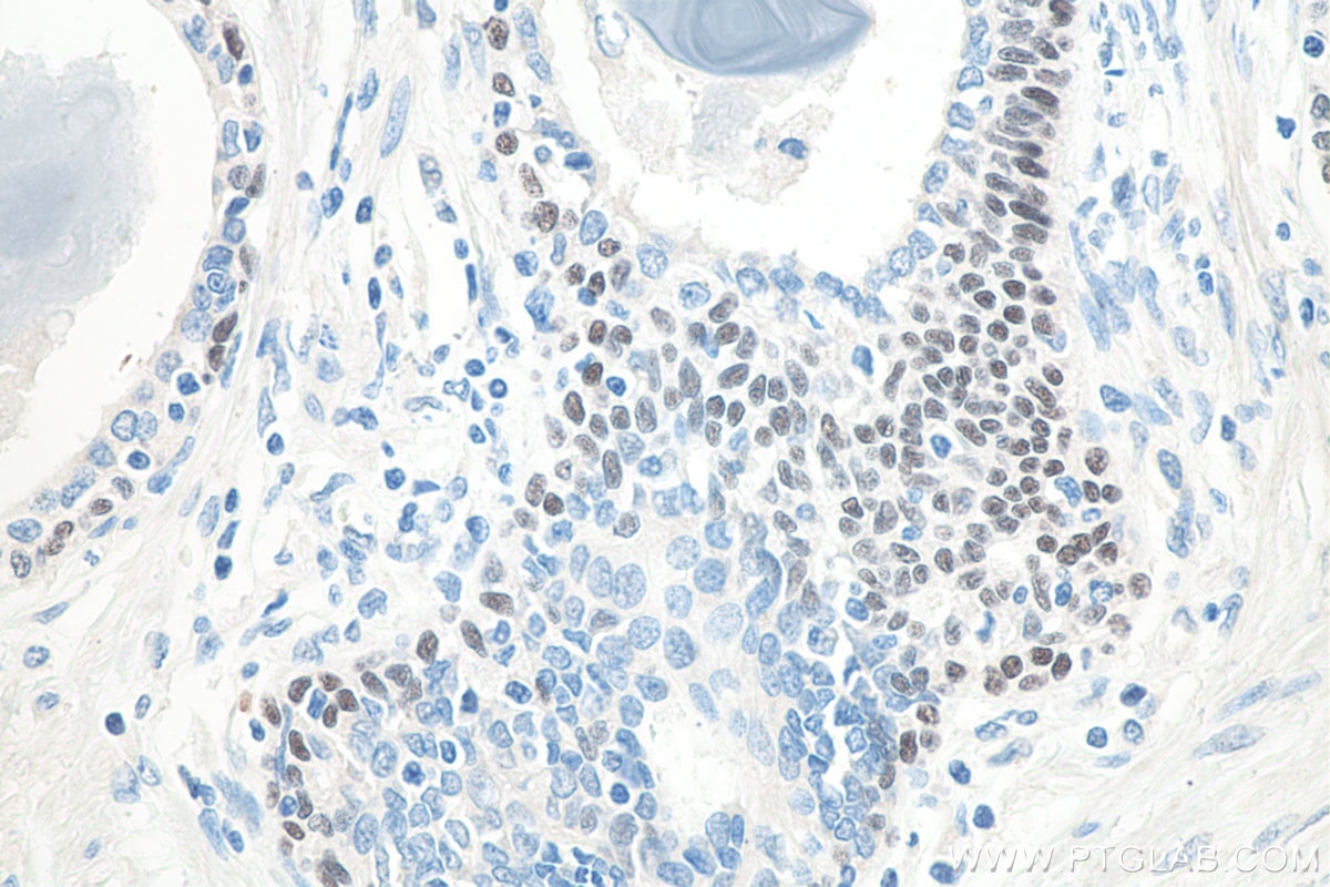 Immunohistochemical analysis of paraffin-embedded human prostate cancer tissue slide using KHC0086 (TP63 IHC Kit).