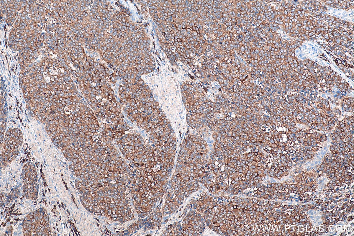 Immunohistochemical analysis of paraffin-embedded human stomach cancer tissue slide using KHC0894 (TPD52 IHC Kit).