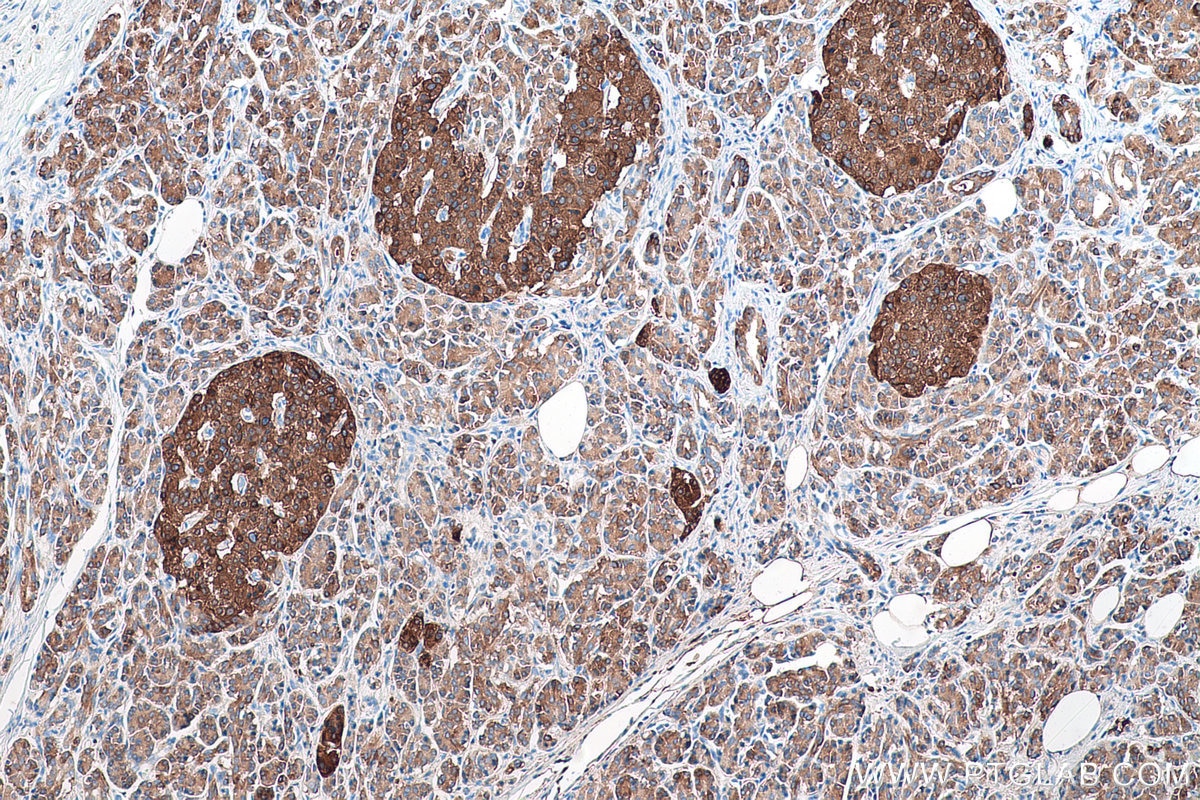 Immunohistochemical analysis of paraffin-embedded human pancreas cancer tissue slide using KHC0894 (TPD52 IHC Kit).