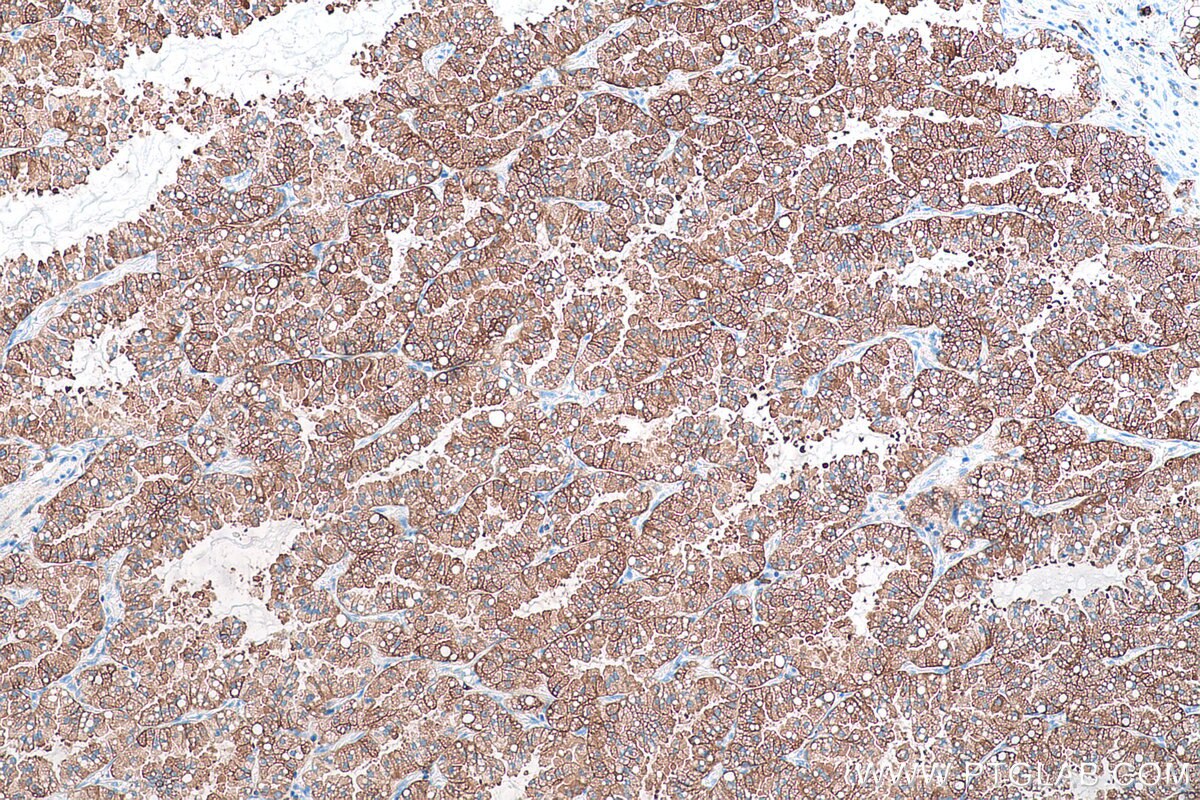 Immunohistochemical analysis of paraffin-embedded human lung cancer tissue slide using KHC0894 (TPD52 IHC Kit).