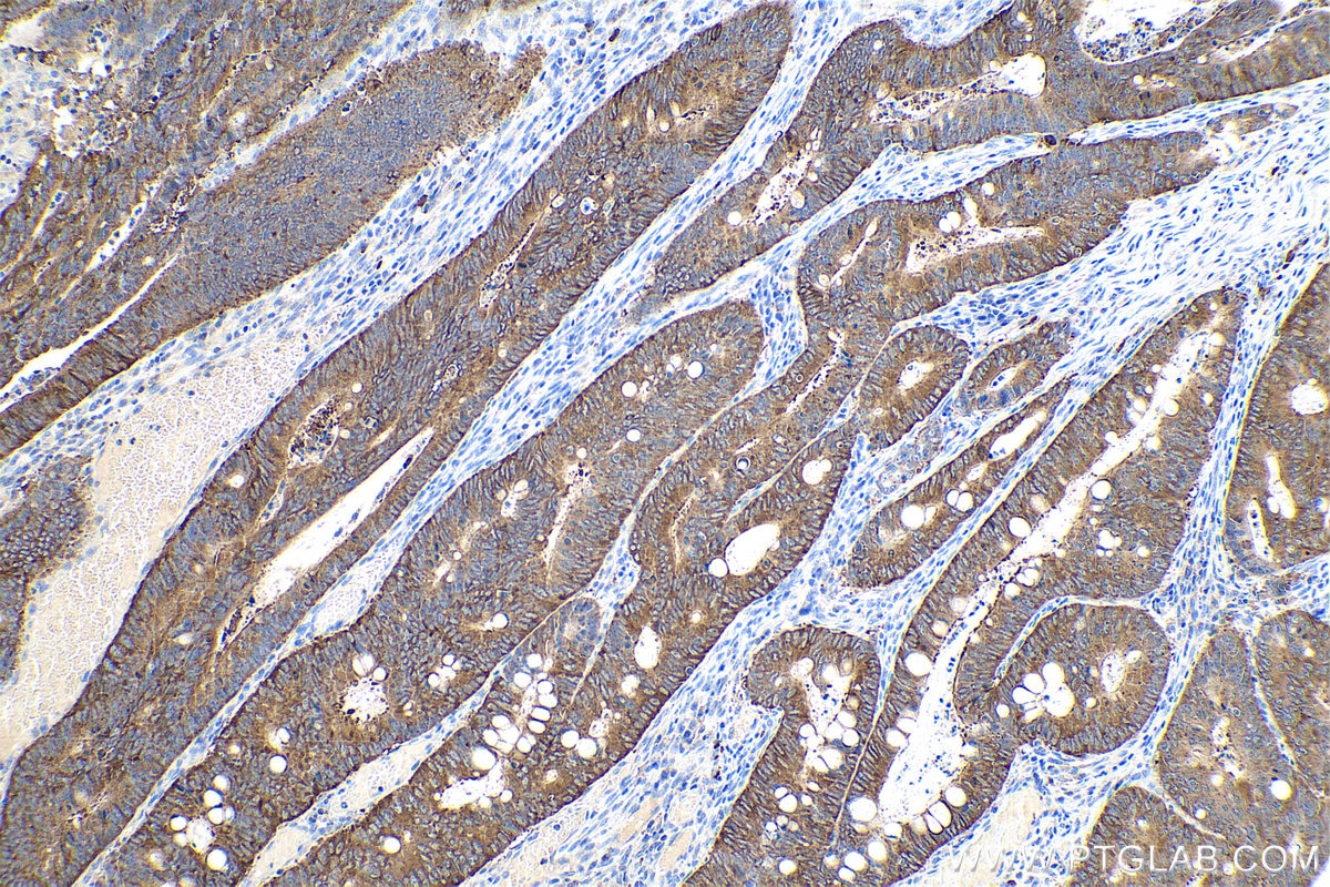 Immunohistochemical analysis of paraffin-embedded human colon cancer tissue slide using KHC0894 (TPD52 IHC Kit).