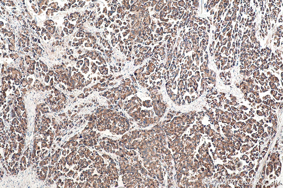 Immunohistochemical analysis of paraffin-embedded human colon cancer tissue slide using KHC0967 (TPD52L1 IHC Kit).