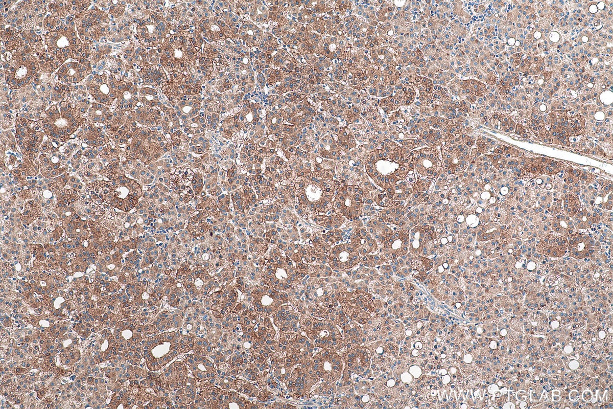 Immunohistochemical analysis of paraffin-embedded human liver cancer tissue slide using KHC0967 (TPD52L1 IHC Kit).