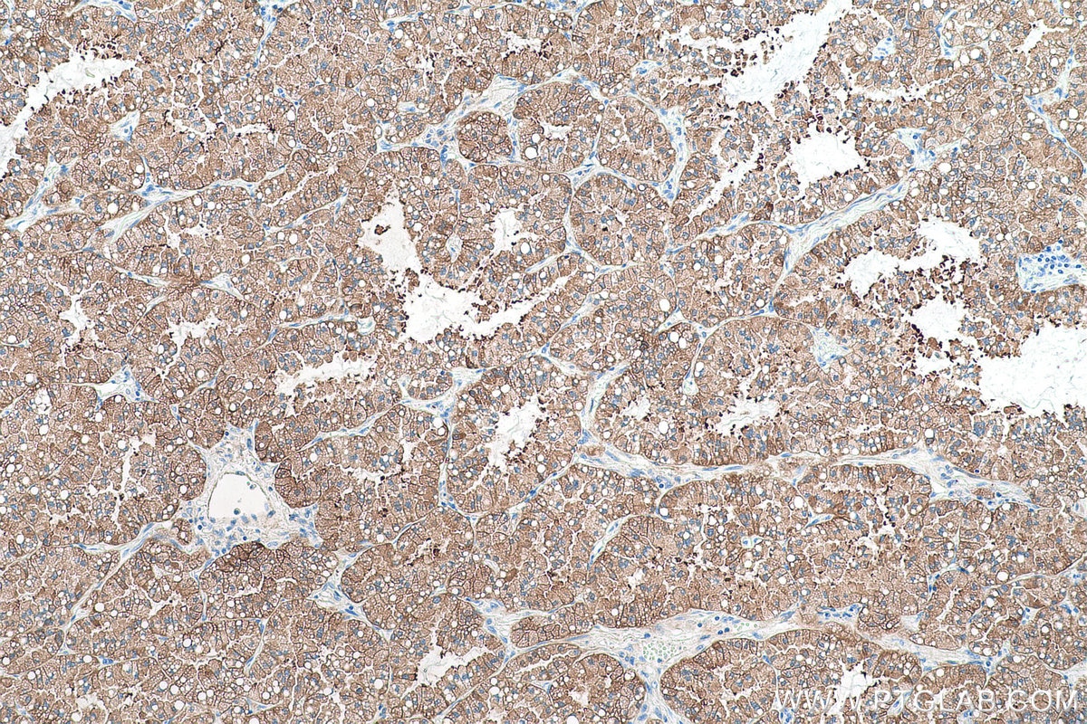 Immunohistochemical analysis of paraffin-embedded human lung cancer tissue slide using KHC0967 (TPD52L1 IHC Kit).