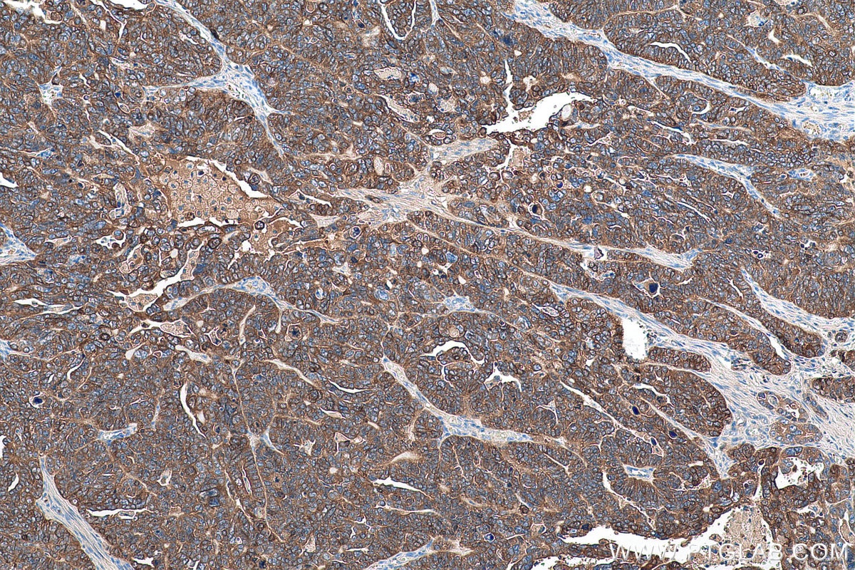 Immunohistochemical analysis of paraffin-embedded human ovary tumor tissue slide using KHC0967 (TPD52L1 IHC Kit).