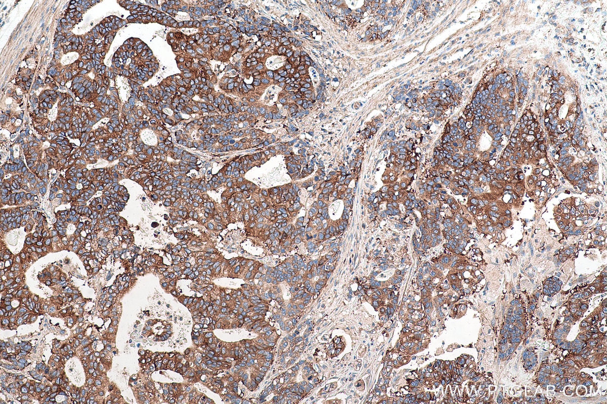 Immunohistochemical analysis of paraffin-embedded human stomach cancer tissue slide using KHC0967 (TPD52L1 IHC Kit).