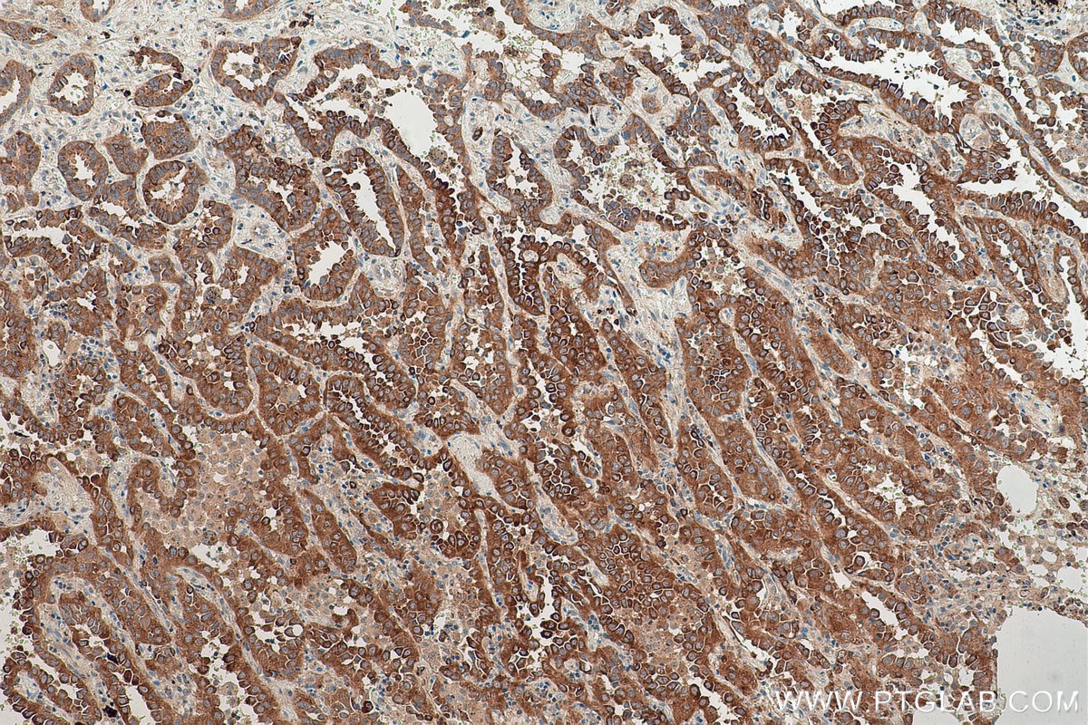 Immunohistochemical analysis of paraffin-embedded human lung cancer tissue slide using KHC0844 (TPD52L2 IHC Kit).