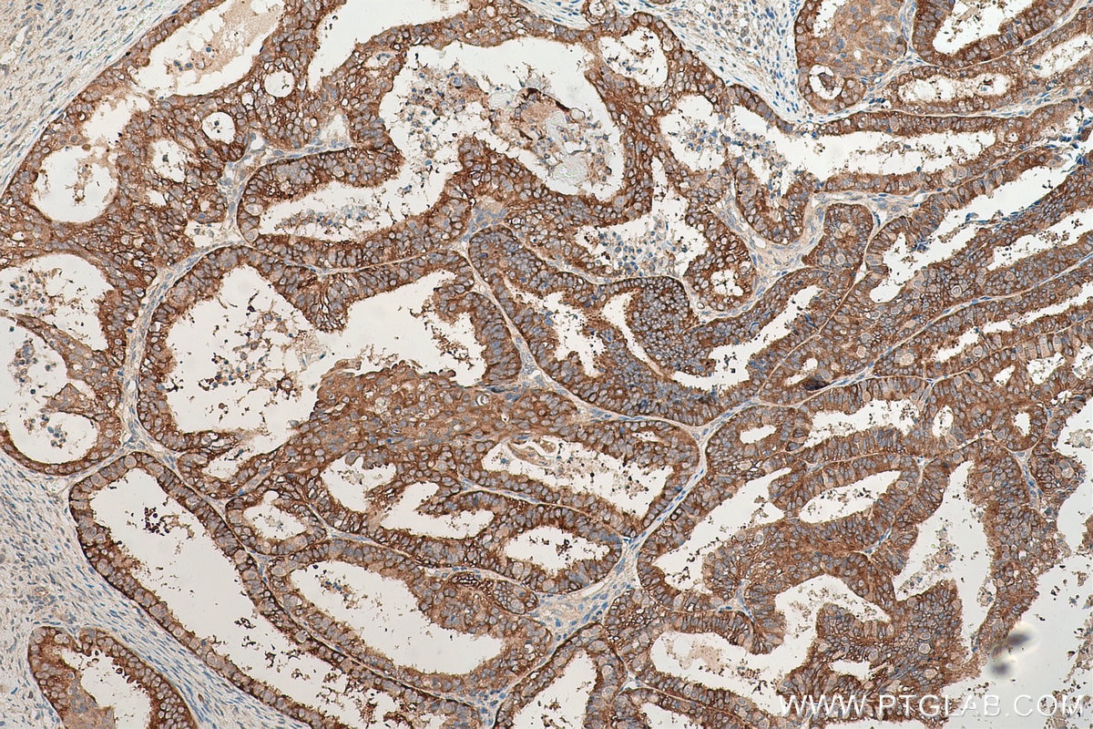Immunohistochemical analysis of paraffin-embedded human ovary tumor tissue slide using KHC0844 (TPD52L2 IHC Kit).