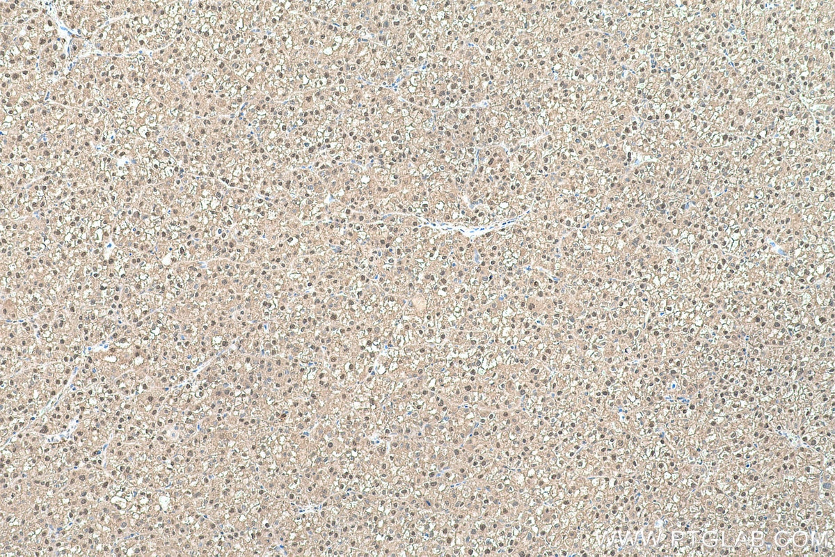 Immunohistochemical analysis of paraffin-embedded human liver cancer tissue slide using KHC0511 (TPI1 IHC Kit).