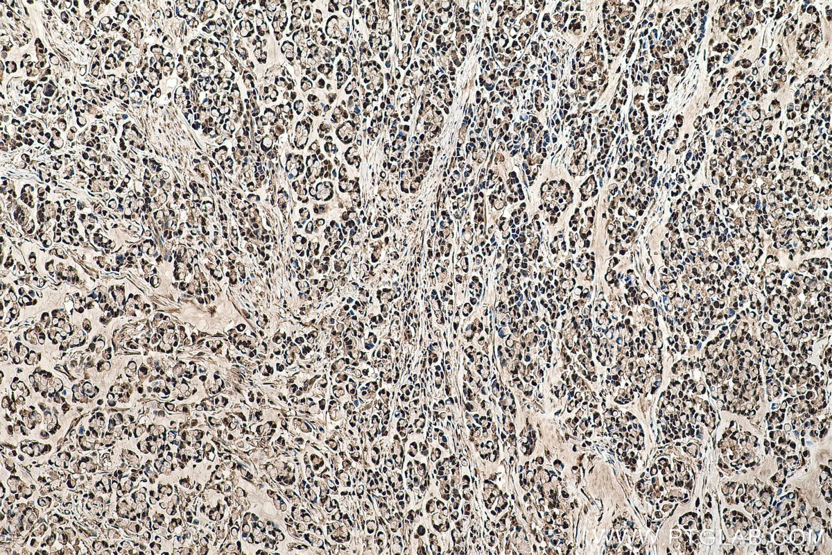 Immunohistochemical analysis of paraffin-embedded human colon cancer tissue slide using KHC0511 (TPI1 IHC Kit).