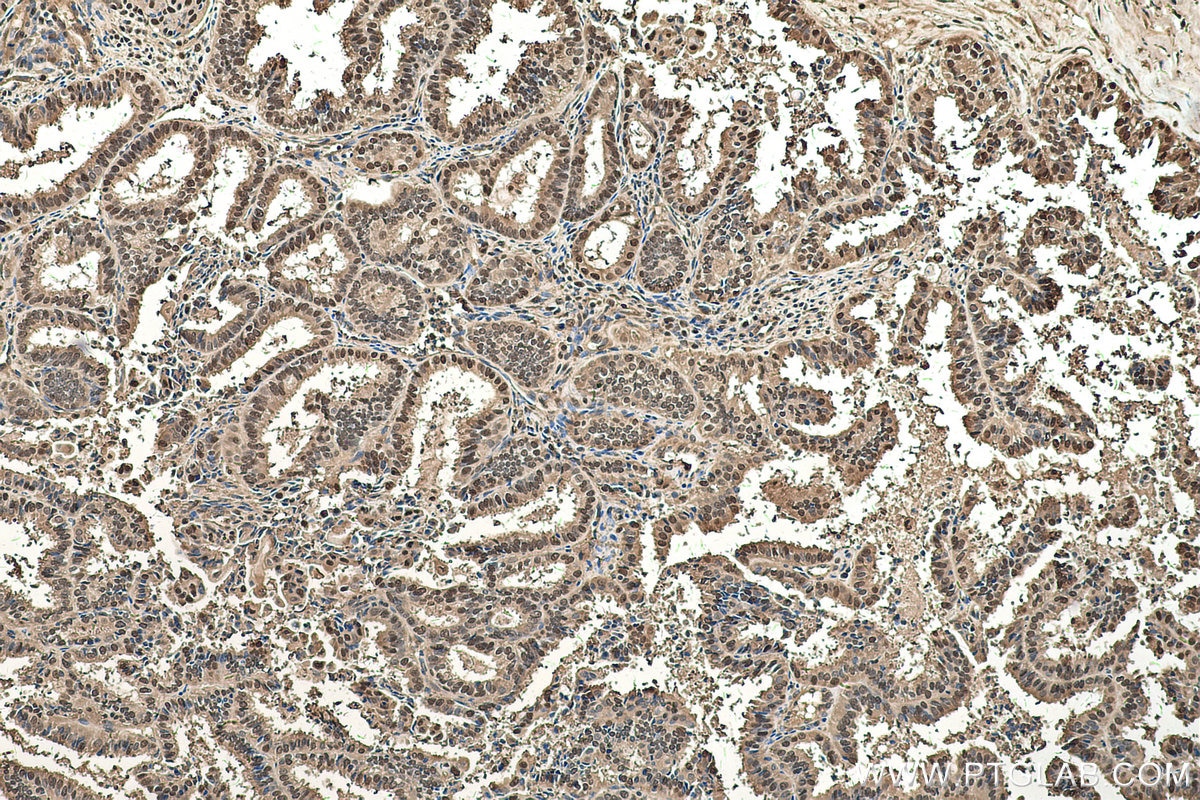 Immunohistochemical analysis of paraffin-embedded human ovary tumor tissue slide using KHC0511 (TPI1 IHC Kit).