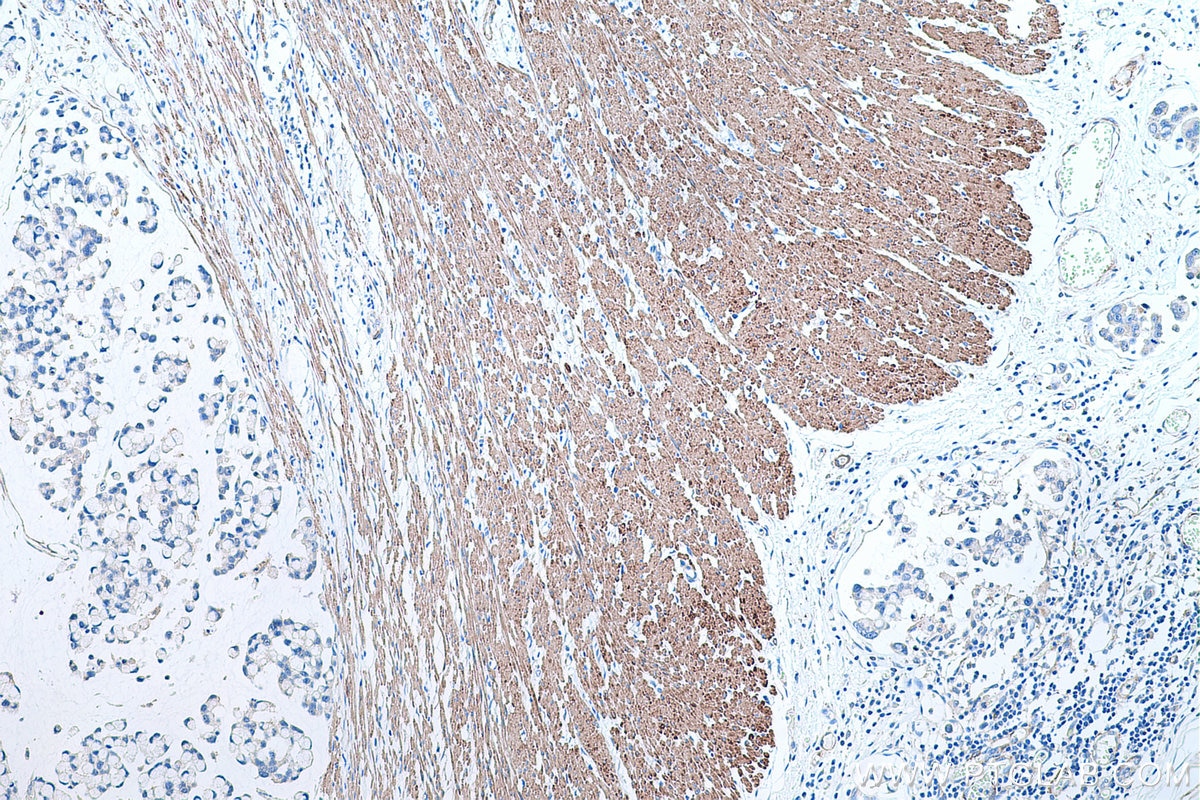 Immunohistochemical analysis of paraffin-embedded human colon cancer tissue slide using KHC0482 (TPM2 IHC Kit).