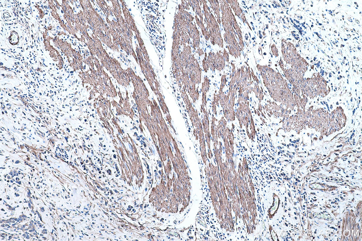 Immunohistochemical analysis of paraffin-embedded human stomach cancer tissue slide using KHC0482 (TPM2 IHC Kit).