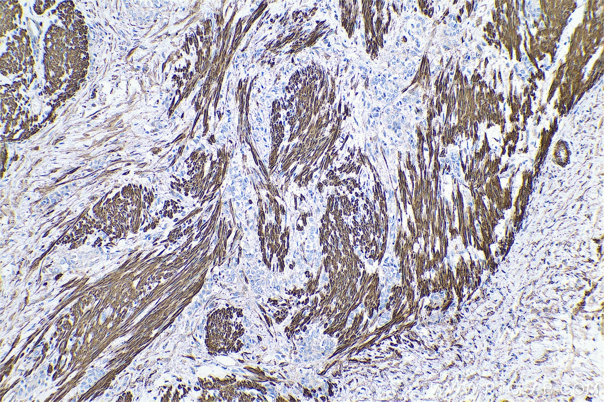 Immunohistochemical analysis of paraffin-embedded human urothelial carcinoma tissue slide using KHC0660 (TPM4 IHC Kit).