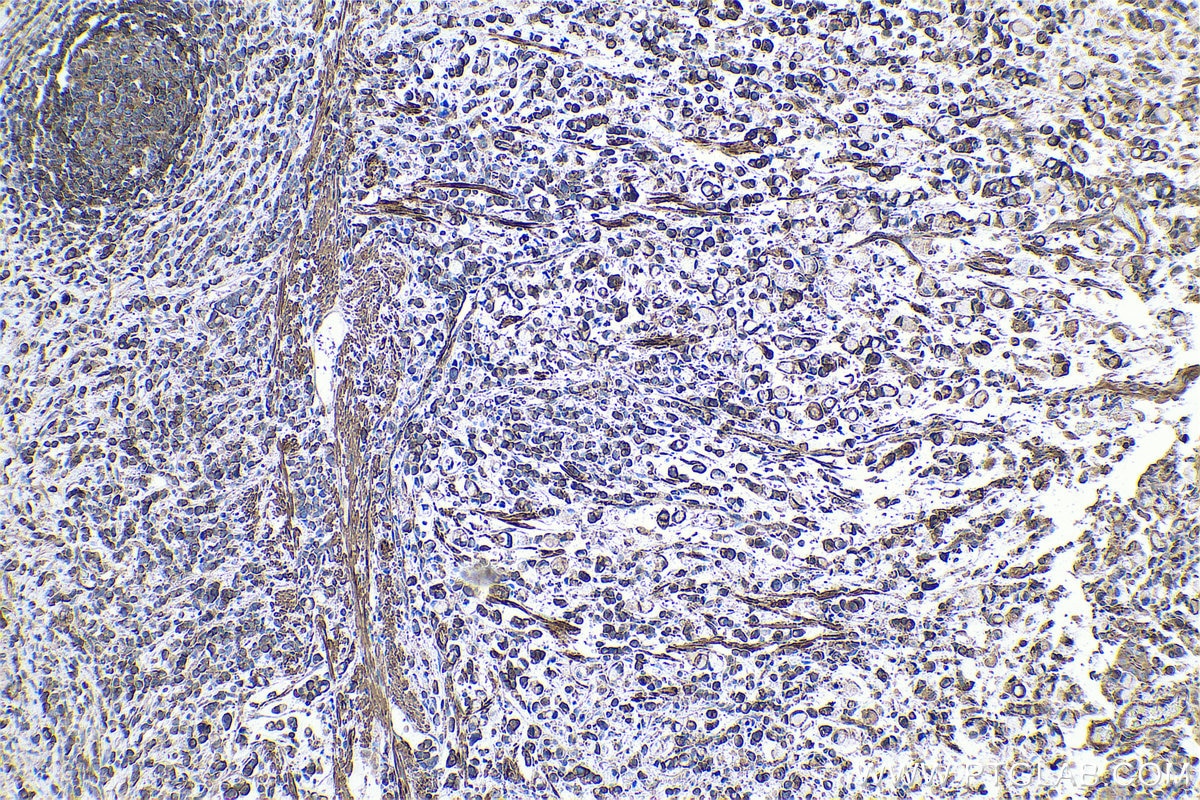 Immunohistochemical analysis of paraffin-embedded human stomach cancer tissue slide using KHC0660 (TPM4 IHC Kit).