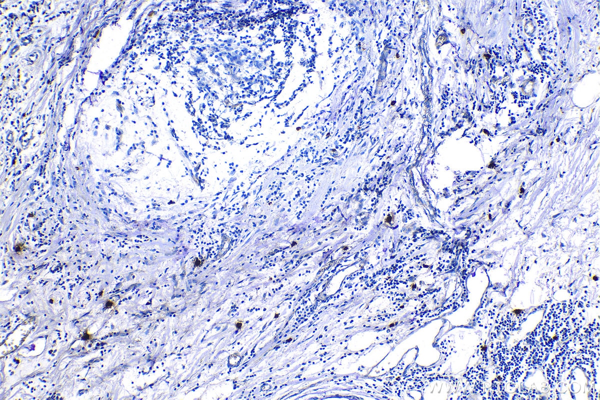 Immunohistochemical analysis of paraffin-embedded human breast cancer tissue slide using KHC1160 (TPSAB1 IHC Kit).