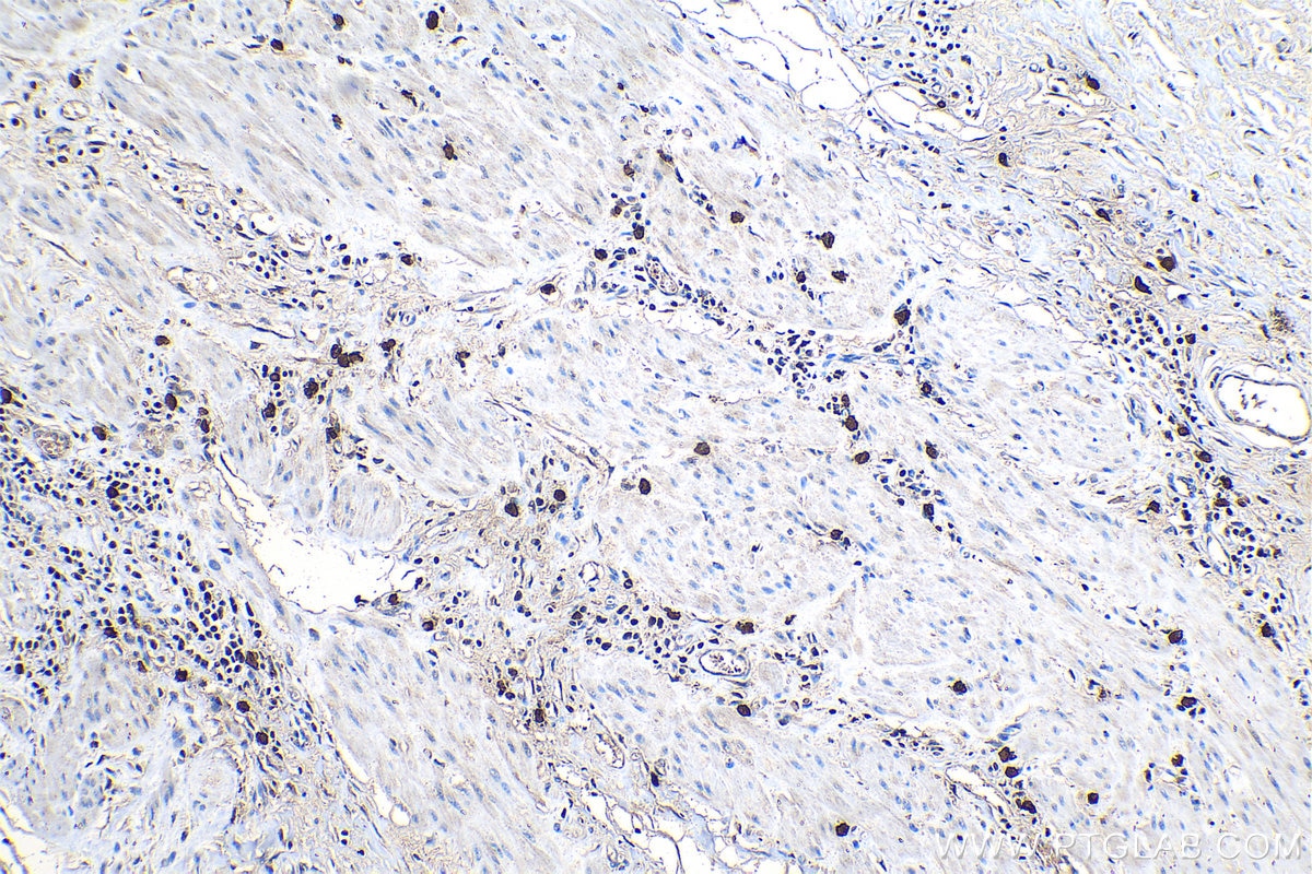 Immunohistochemical analysis of paraffin-embedded human stomach cancer tissue slide using KHC1160 (TPSAB1 IHC Kit).