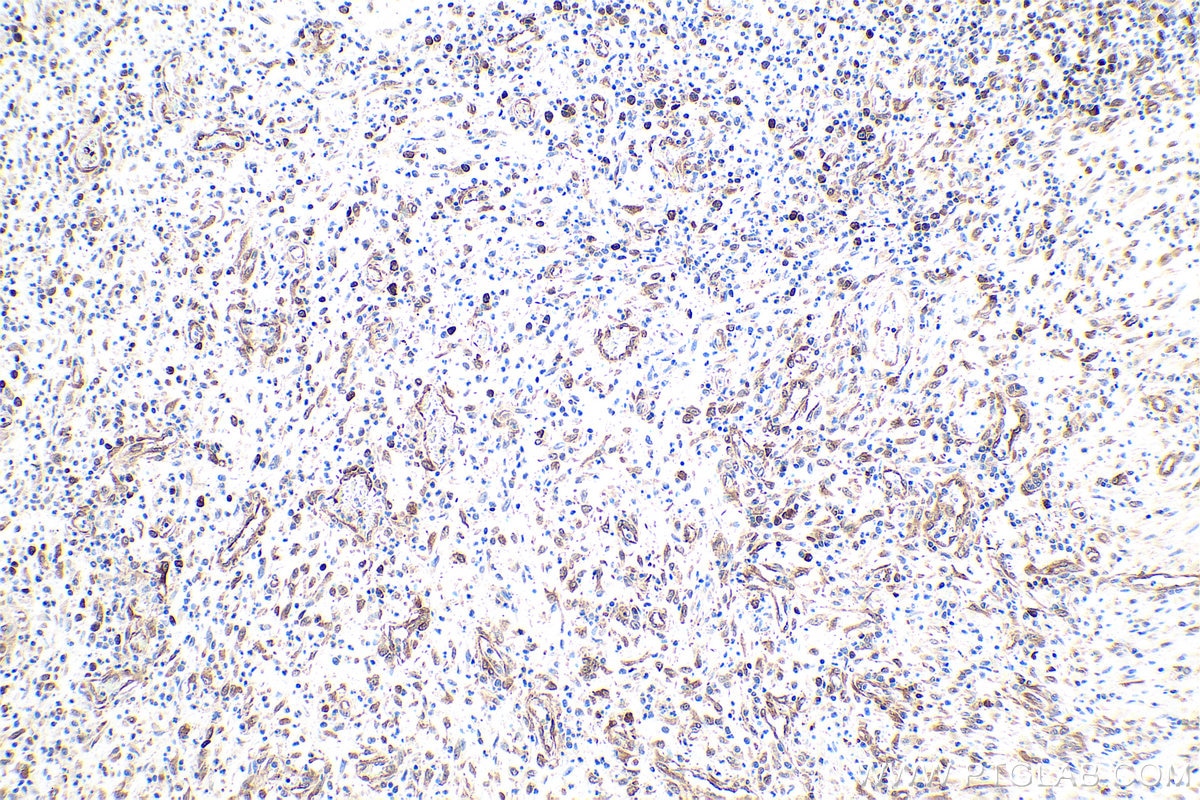 Immunohistochemical analysis of paraffin-embedded human colon cancer tissue slide using KHC0874 (TPT1 IHC Kit).