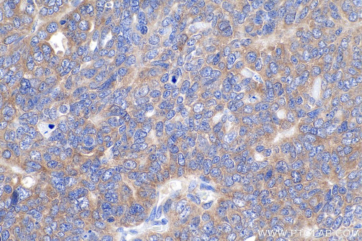 Immunohistochemical analysis of paraffin-embedded human ovary tumor tissue slide using KHC0874 (TPT1 IHC Kit).