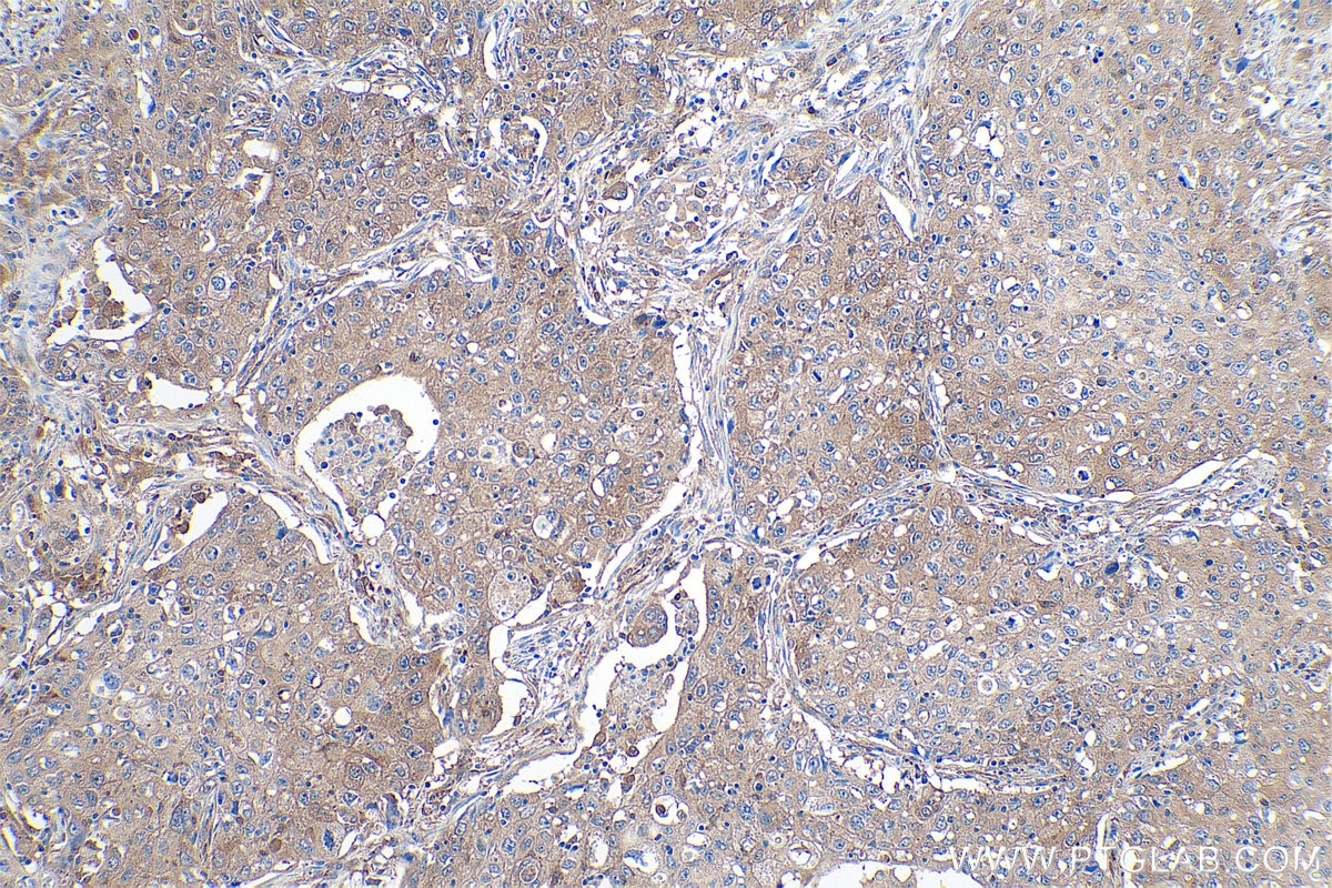 Immunohistochemical analysis of paraffin-embedded human lung cancer tissue slide using KHC0874 (TPT1 IHC Kit).