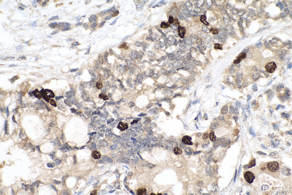 Immunohistochemical analysis of paraffin-embedded human pancreas cancer tissue slide using KHC0806 (TPX2 IHC Kit).