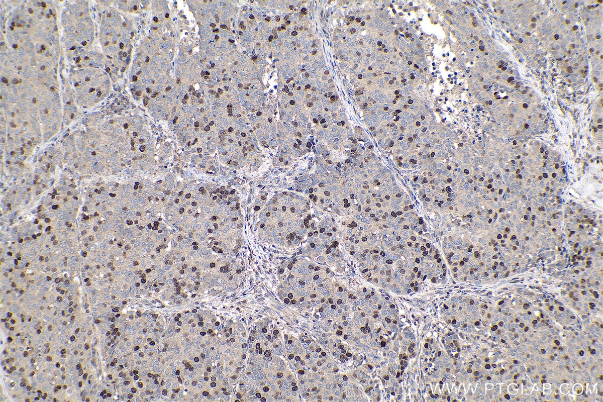 Immunohistochemical analysis of paraffin-embedded human stomach cancer tissue slide using KHC0806 (TPX2 IHC Kit).