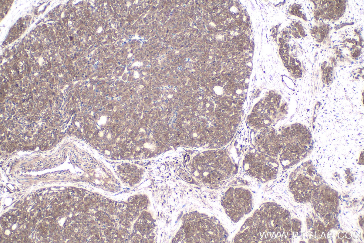 Immunohistochemical analysis of paraffin-embedded human thyroid cancer tissue slide using KHC1755 (TRADD IHC Kit).