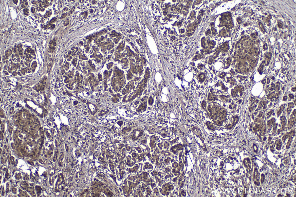 Immunohistochemical analysis of paraffin-embedded human pancreas cancer tissue slide using KHC1157 (TRAF6 IHC Kit).