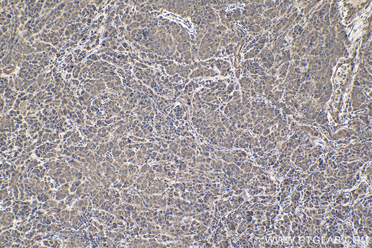 Immunohistochemical analysis of paraffin-embedded human malignant melanoma tissue slide using KHC1906 (TRAIP IHC Kit).