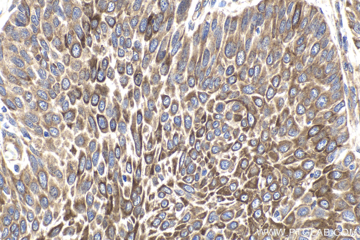 Immunohistochemical analysis of paraffin-embedded human oesophagus cancer tissue slide using KHC1906 (TRAIP IHC Kit).