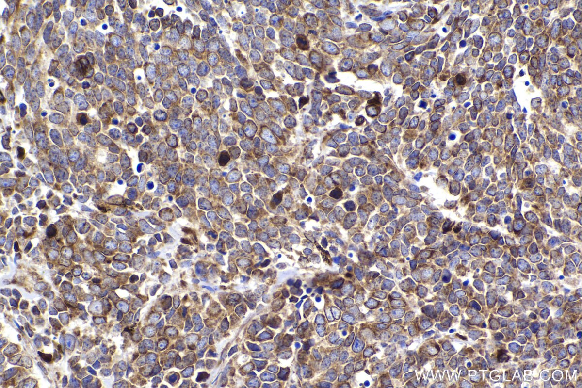 Immunohistochemical analysis of paraffin-embedded human lung cancer tissue slide using KHC2264 (TRAPA/SSR1 IHC Kit).