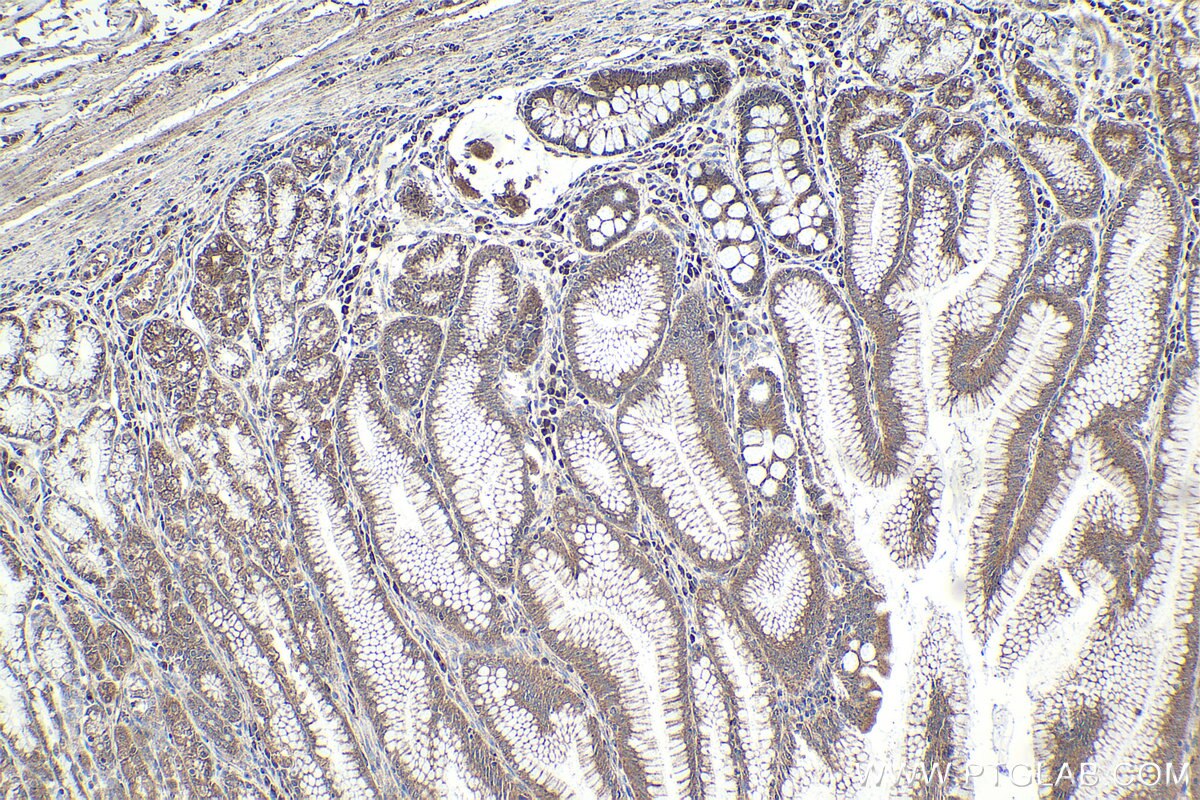 Immunohistochemical analysis of paraffin-embedded human stomach cancer tissue slide using KHC1914 (TRIM15 IHC Kit).