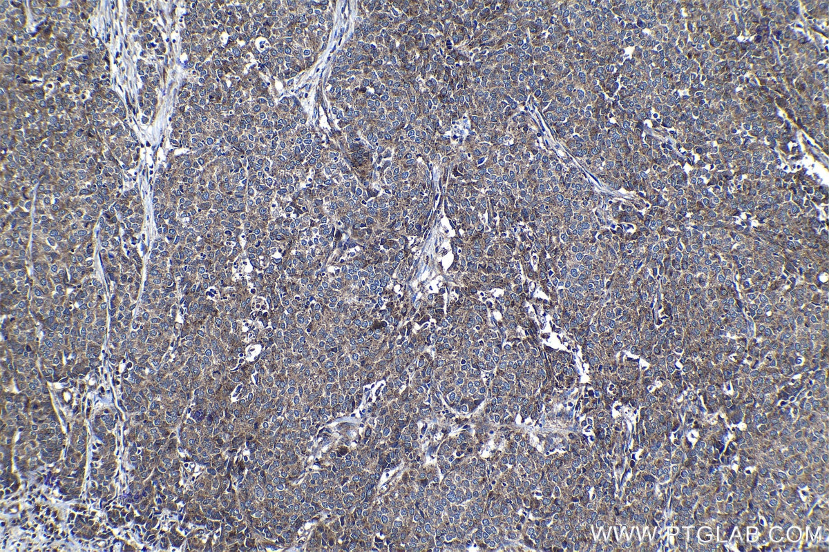 Immunohistochemical analysis of paraffin-embedded human stomach cancer tissue slide using KHC1175 (TRIM16 IHC Kit).