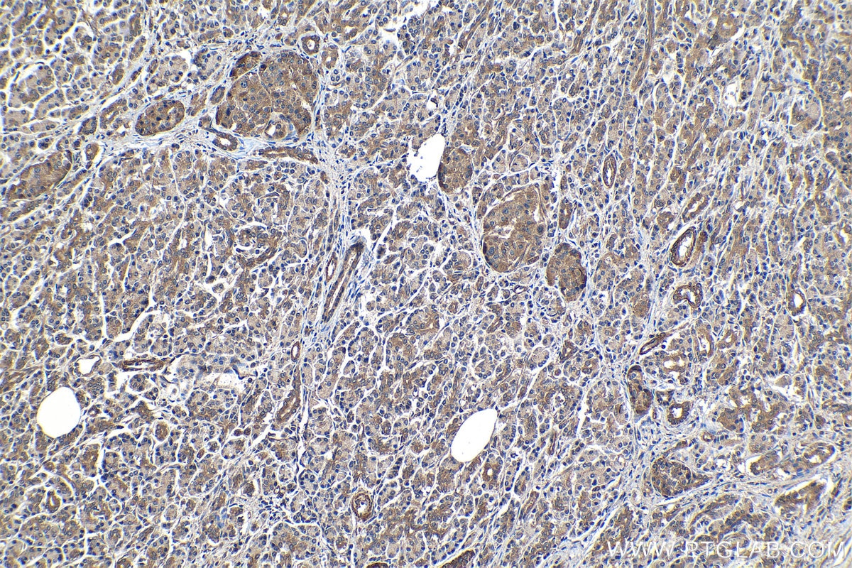 Immunohistochemical analysis of paraffin-embedded human pancreas cancer tissue slide using KHC1177 (TRIM21 IHC Kit).