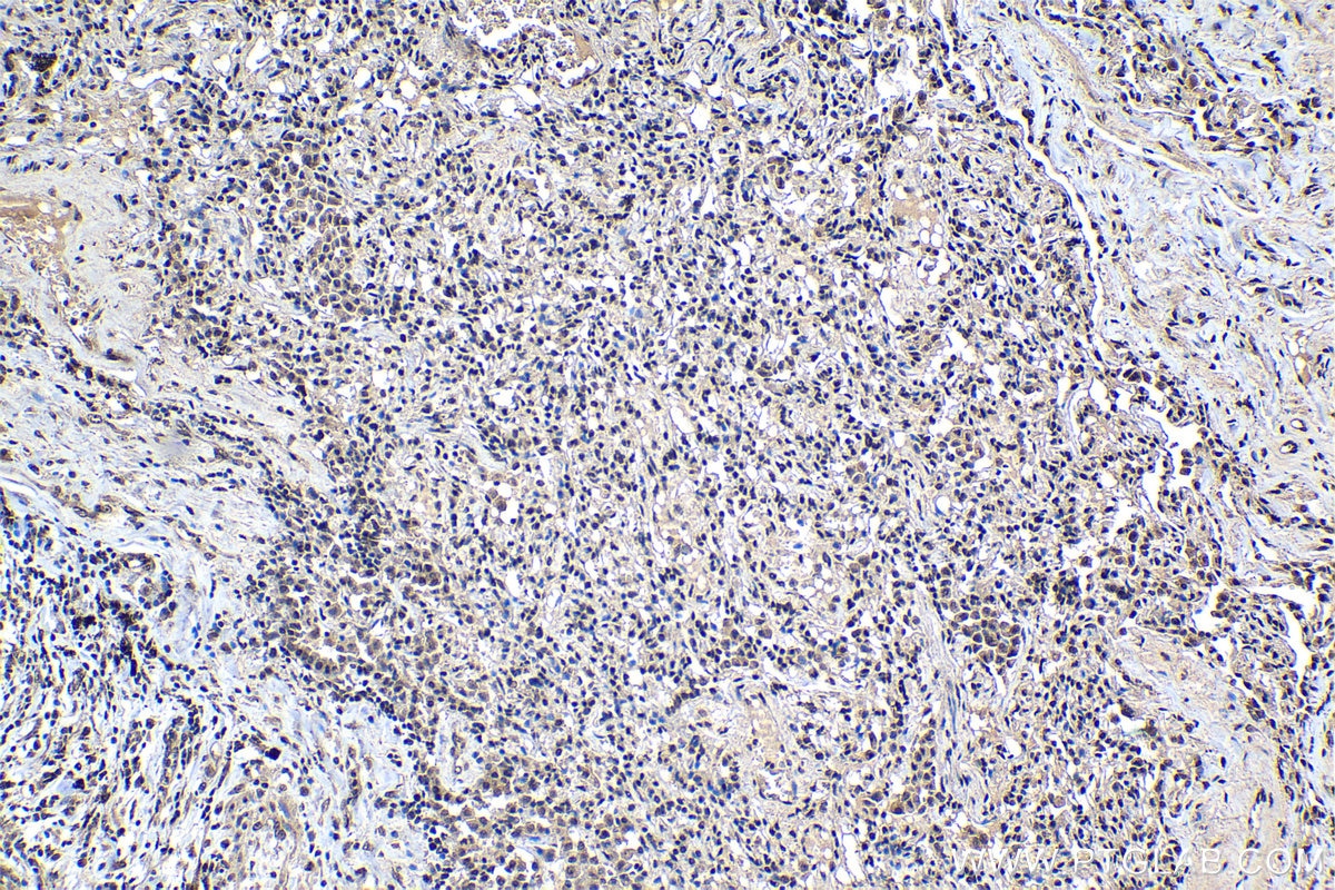 Immunohistochemical analysis of paraffin-embedded human lung cancer tissue slide using KHC1176 (TRIM24 IHC Kit).