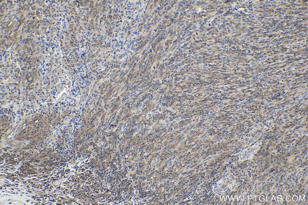 Immunohistochemical analysis of paraffin-embedded human skin cancer tissue slide using KHC1729 (TRIM25 IHC Kit).