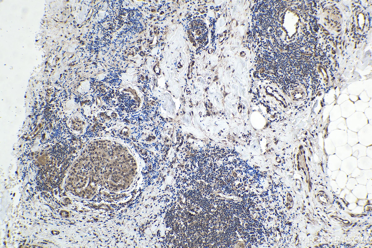 Immunohistochemical analysis of paraffin-embedded human thyroid cancer tissue slide using KHC1729 (TRIM25 IHC Kit).