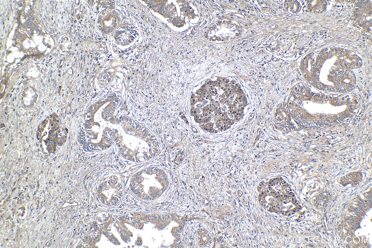 Immunohistochemical analysis of paraffin-embedded human pancreas cancer tissue slide using KHC1216 (TRIM26 IHC Kit).