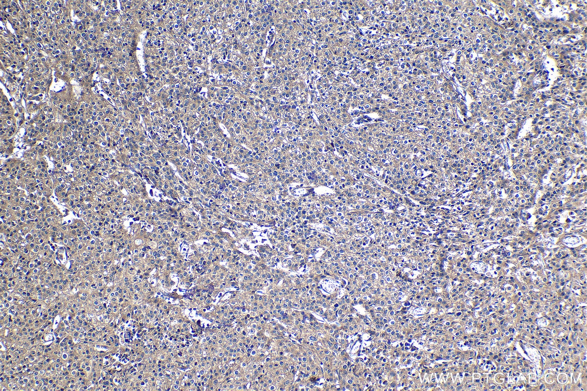 Immunohistochemical analysis of paraffin-embedded human cervical cancer tissue slide using KHC1216 (TRIM26 IHC Kit).