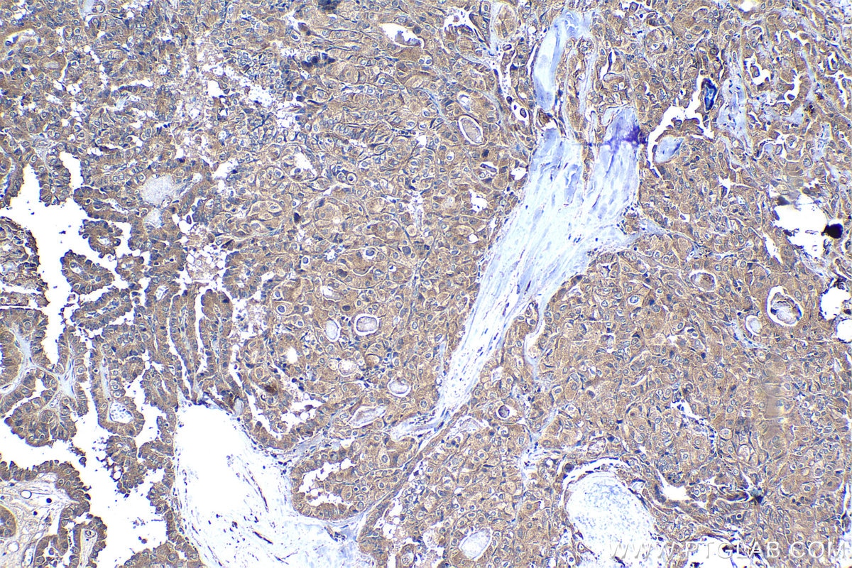 Immunohistochemical analysis of paraffin-embedded human thyroid cancer tissue slide using KHC1216 (TRIM26 IHC Kit).