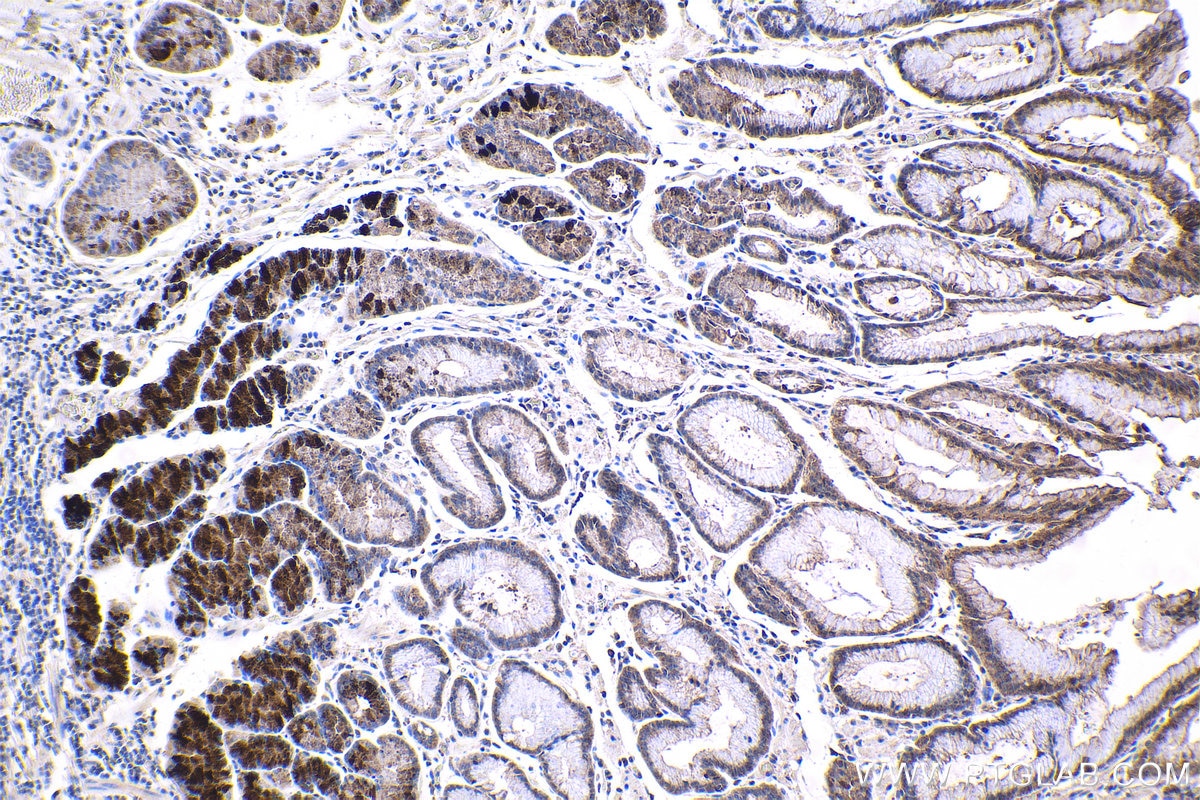 Immunohistochemical analysis of paraffin-embedded human stomach cancer tissue slide using KHC1532 (TRIM27 IHC Kit).