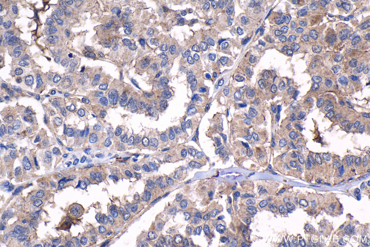 Immunohistochemical analysis of paraffin-embedded human thyroid cancer tissue slide using KHC1532 (TRIM27 IHC Kit).