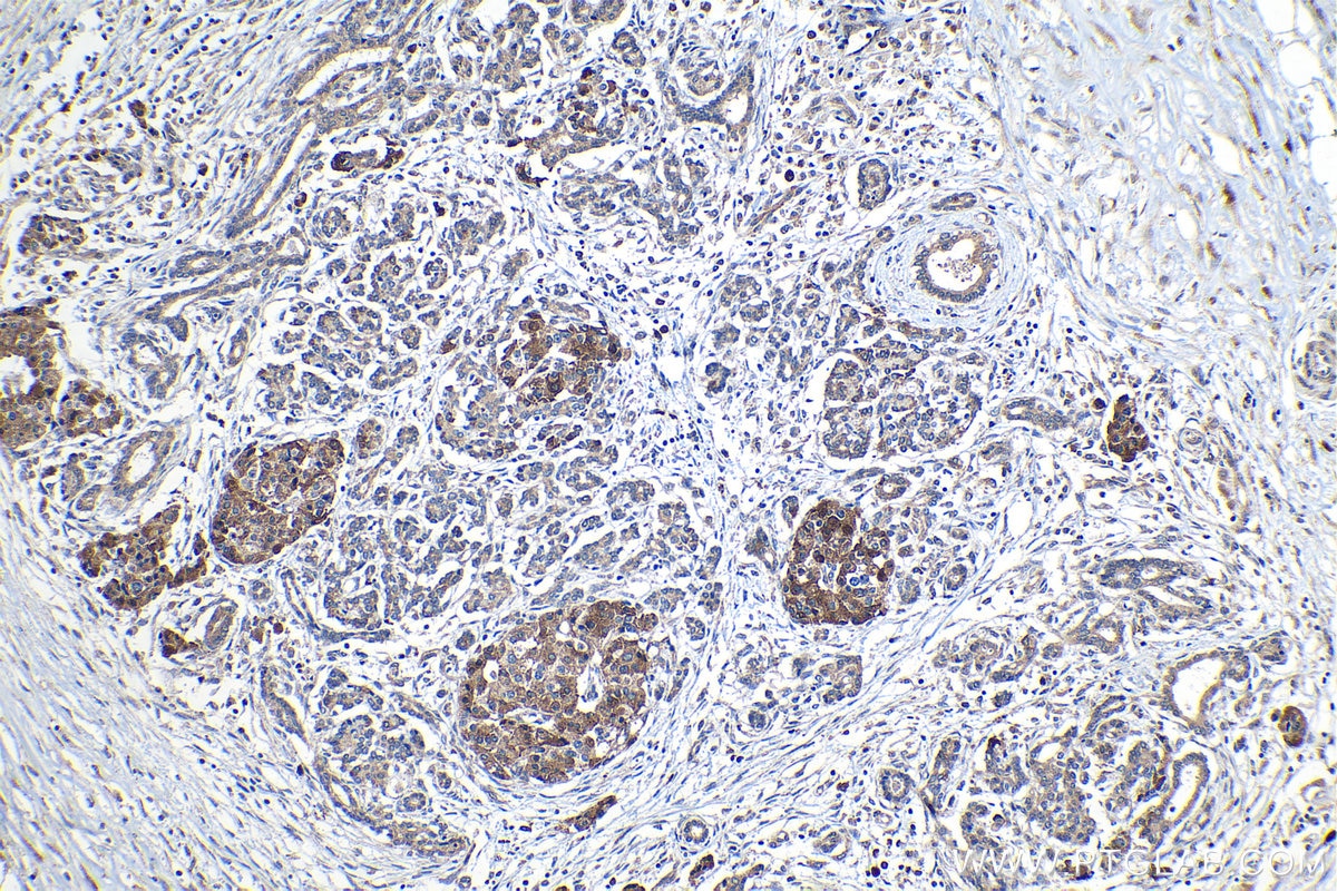 Immunohistochemical analysis of paraffin-embedded human pancreas cancer tissue slide using KHC1179 (TRIM32 IHC Kit).