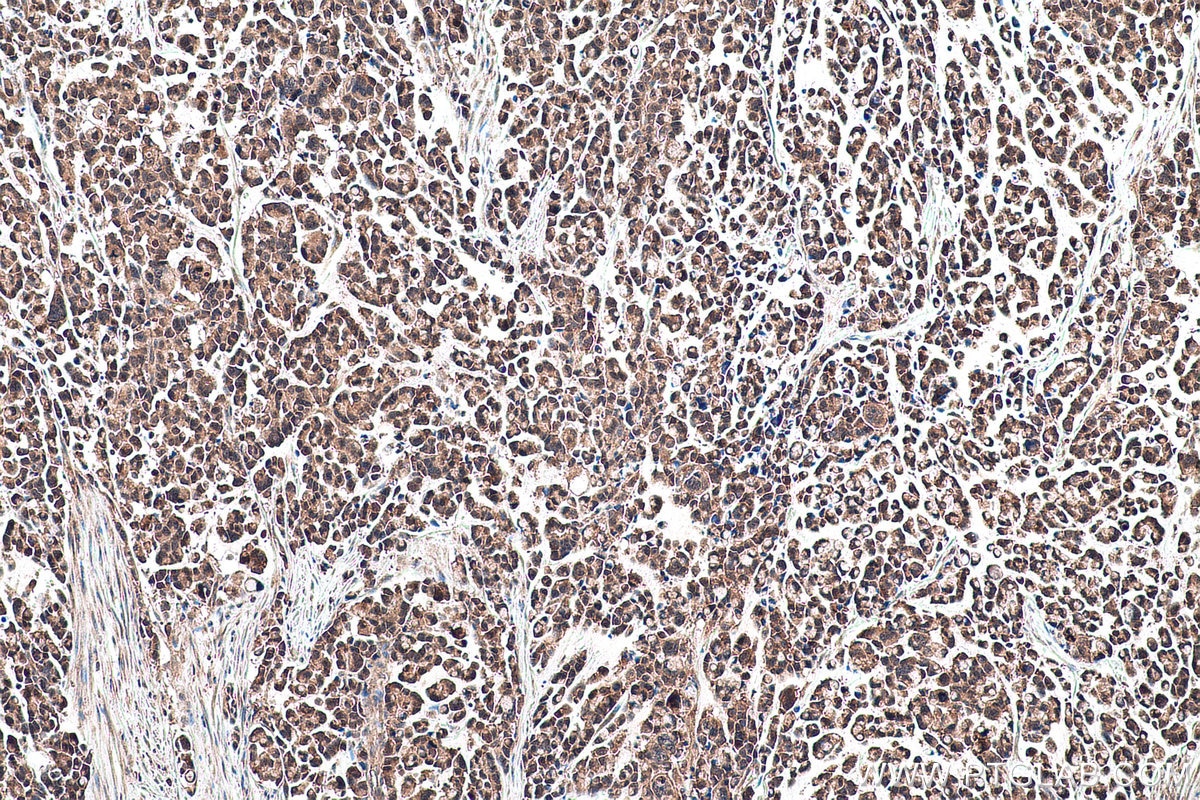 Immunohistochemical analysis of paraffin-embedded human colon cancer tissue slide using KHC0966 (TRIM47 IHC Kit).