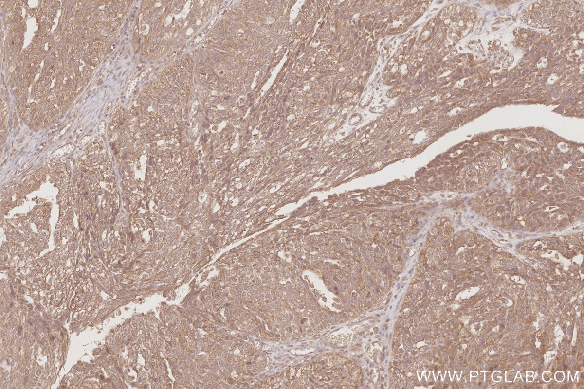 Immunohistochemical analysis of paraffin-embedded human ovary cancer tissue slide using KHC2890 (TRIM5 IHC Kit).