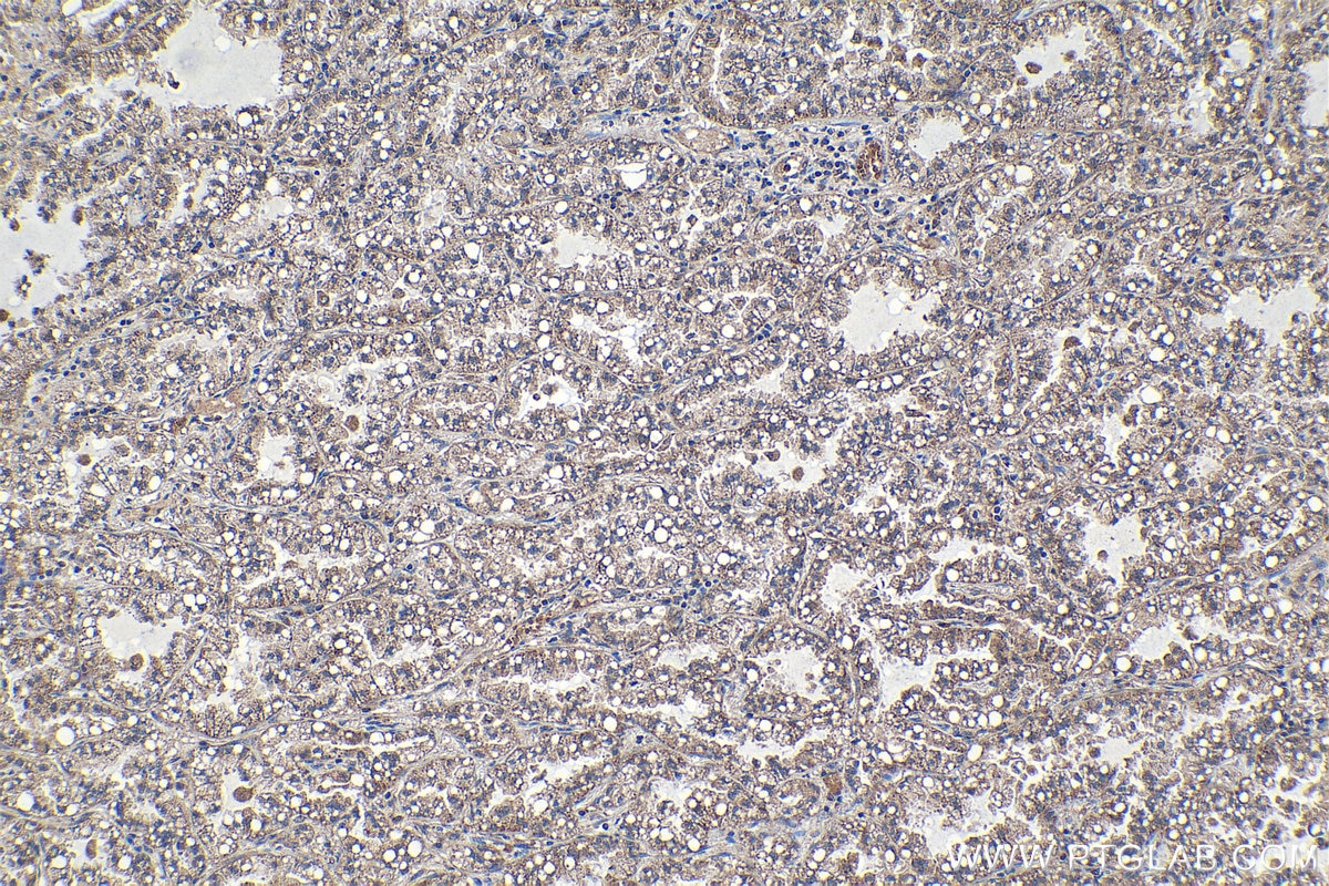 Immunohistochemical analysis of paraffin-embedded human lung cancer tissue slide using KHC1173 (TRIM59 IHC Kit).