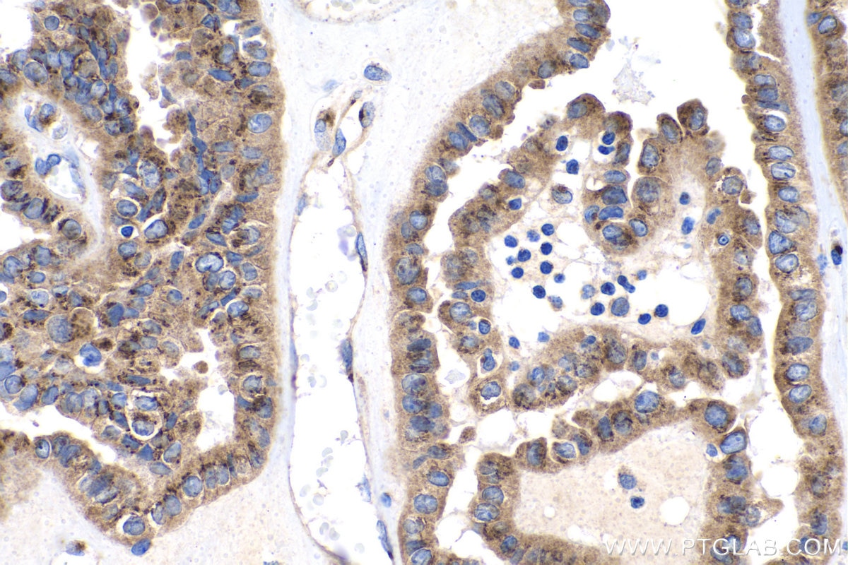 Immunohistochemical analysis of paraffin-embedded human thyroid cancer tissue slide using KHC1382 (TRIP11 IHC Kit).