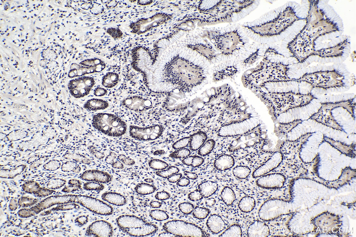 Immunohistochemical analysis of paraffin-embedded human stomach cancer tissue slide using KHC0989 (C19orf43 IHC Kit).